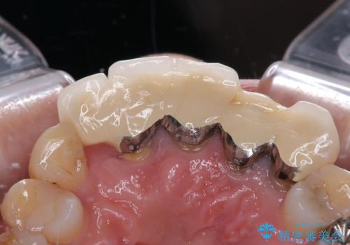 不具合の多い前歯 オールセラミックブリッジ治療の治療前
