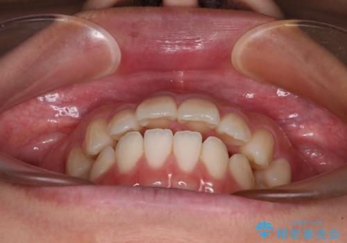 横顔の印象を変えたい ワイヤー装置での抜歯矯正の治療前