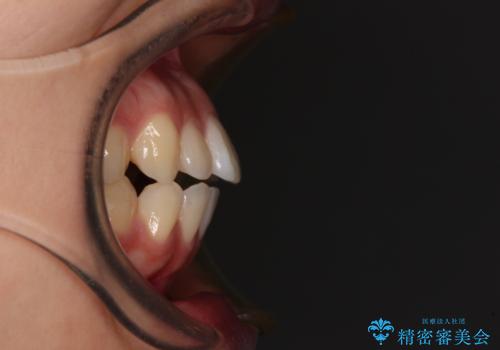 横顔の印象を変えたい ワイヤー装置での抜歯矯正の治療前