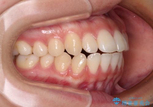 横顔の印象を変えたい ワイヤー装置での抜歯矯正の治療前