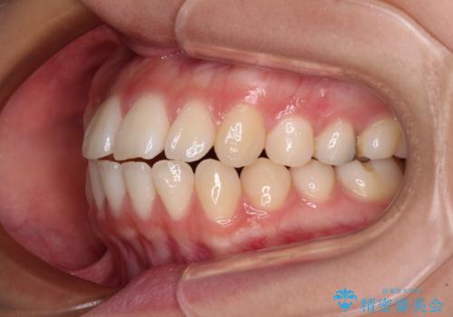 横顔の印象を変えたい ワイヤー装置での抜歯矯正の治療前