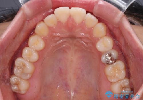 横顔の印象を変えたい ワイヤー装置での抜歯矯正の治療前