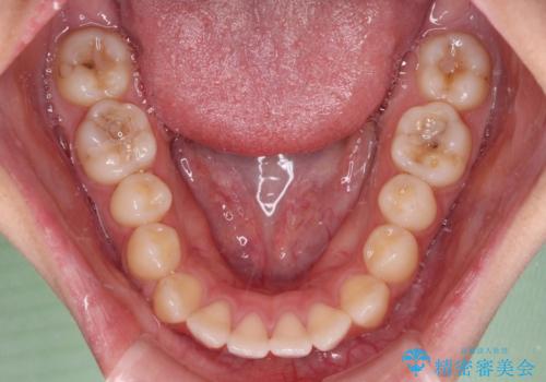 横顔の印象を変えたい ワイヤー装置での抜歯矯正の治療前