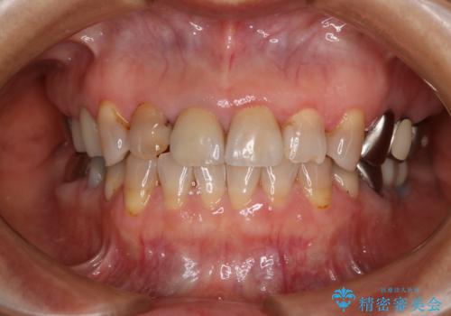 前歯を綺麗にしたい オールセラミッククラウンの症例 治療前