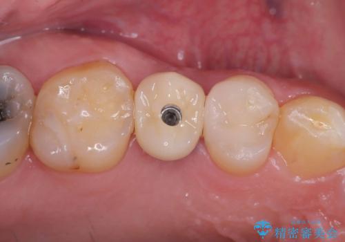 低侵襲なインプラント|痛くないインプラント|エンドペリオ病変|虫歯治療|セラッミクインレーの治療後