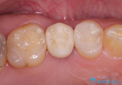 低侵襲なインプラント|痛くないインプラント|エンドペリオ病変|虫歯治療|セラッミクインレーの症例 治療後