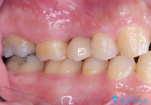 低侵襲なインプラント|痛くないインプラント|エンドペリオ病変|虫歯治療|セラッミクインレーの治療後