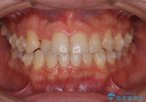 【インビザラインモニター】前歯のがたつき気になるの治療中