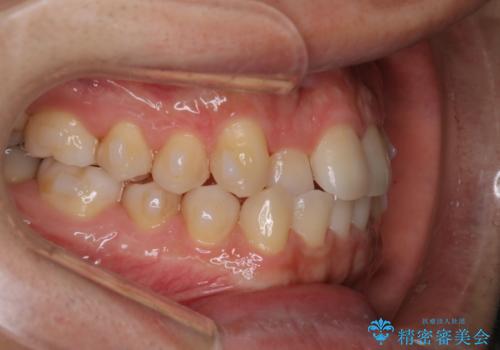 【インビザラインモニター】前歯のがたつき気になるの治療中