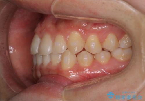 【インビザラインモニター】前歯のがたつき気になるの治療中