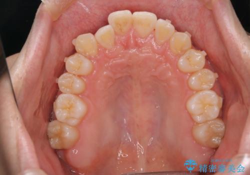 【インビザラインモニター】前歯のがたつき気になるの治療中