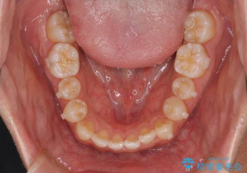 【インビザラインモニター】前歯のがたつき気になるの治療中