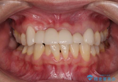 不具合の多い前歯 オールセラミックブリッジ治療の治療後