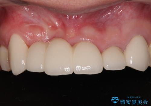 不具合の多い前歯 オールセラミックブリッジ治療の症例 治療後