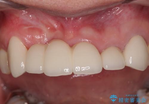 不具合の多い前歯 オールセラミックブリッジ治療の治療後