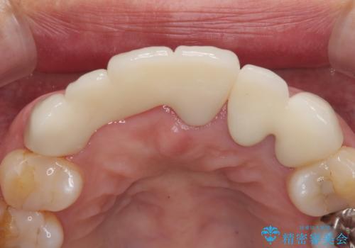 不具合の多い前歯 オールセラミックブリッジ治療の治療後