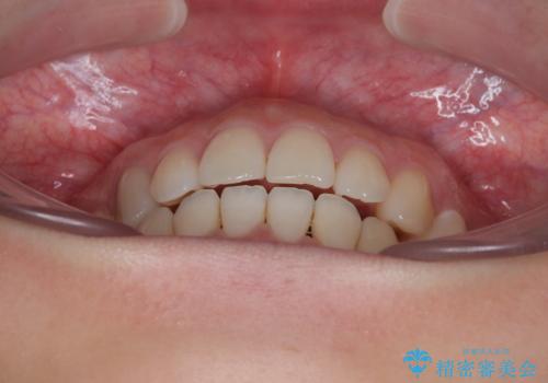 横顔の印象を変えたい ワイヤー装置での抜歯矯正の治療後