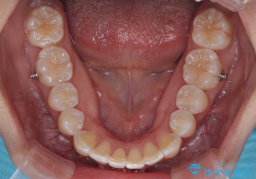 前歯のデコボコを治したい インビザライン矯正の治療中