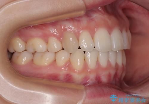 横顔の印象を変えたい ワイヤー装置での抜歯矯正の治療後