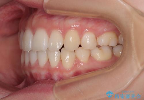 横顔の印象を変えたい ワイヤー装置での抜歯矯正の治療後