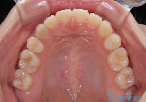 横顔の印象を変えたい ワイヤー装置での抜歯矯正の治療後