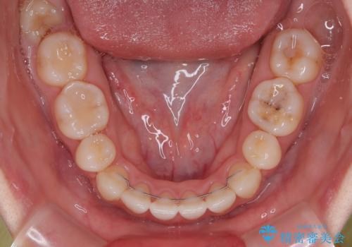 横顔の印象を変えたい ワイヤー装置での抜歯矯正の治療後