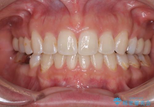 出っ歯と奥歯のむし歯 ワイヤー装置での抜歯矯正とセラミック治療の症例 治療後