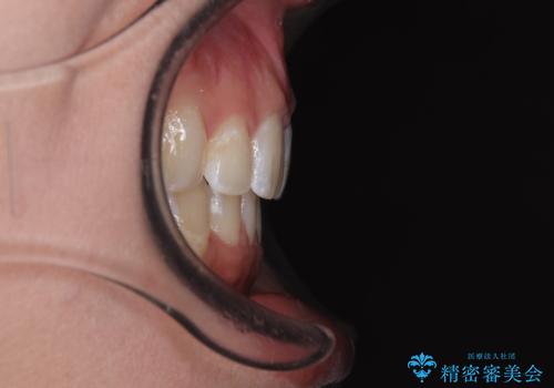 出っ歯と奥歯のむし歯 ワイヤー装置での抜歯矯正とセラミック治療の治療後