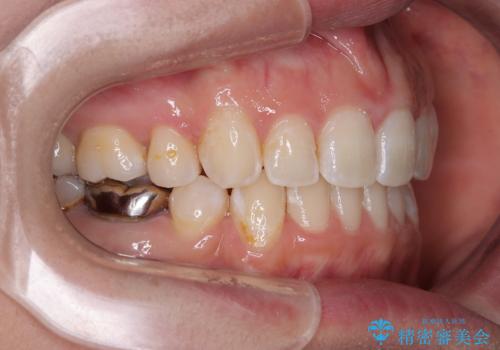 出っ歯と奥歯のむし歯 ワイヤー装置での抜歯矯正とセラミック治療の治療後