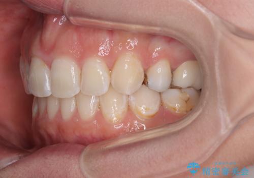 出っ歯と奥歯のむし歯 ワイヤー装置での抜歯矯正とセラミック治療の治療後