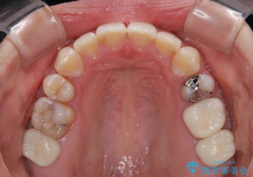 出っ歯と奥歯のむし歯 ワイヤー装置での抜歯矯正とセラミック治療の治療後