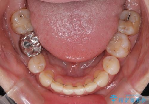 出っ歯と奥歯のむし歯 ワイヤー装置での抜歯矯正とセラミック治療の治療後