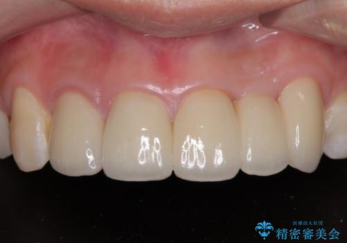 以前の治療箇所が痛む 全顎的なむし歯治療の症例 治療後