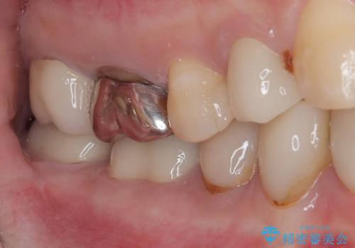 以前の治療箇所が痛む 全顎的なむし歯治療の治療後