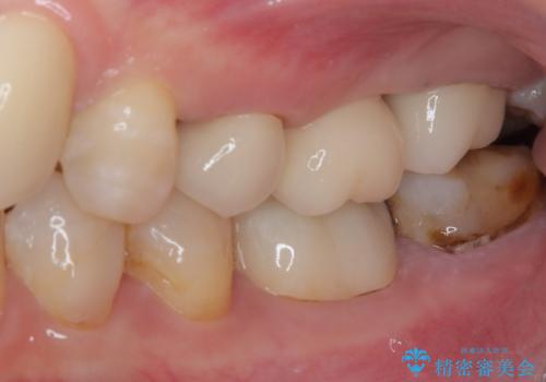 以前の治療箇所が痛む 全顎的なむし歯治療の治療後
