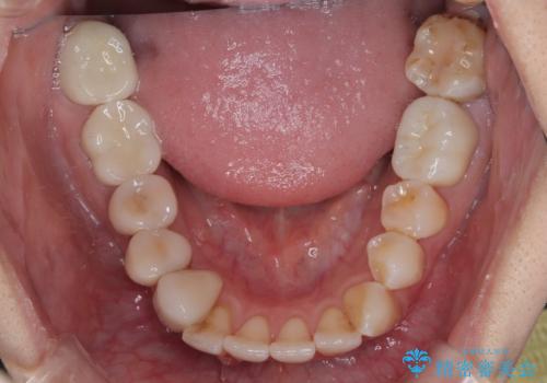 以前の治療箇所が痛む 全顎的なむし歯治療の治療後