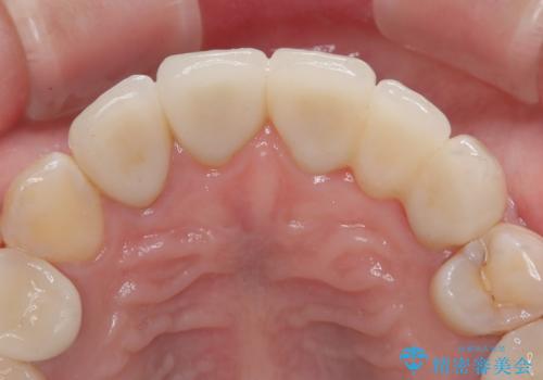 以前の治療箇所が痛む 全顎的なむし歯治療の治療後