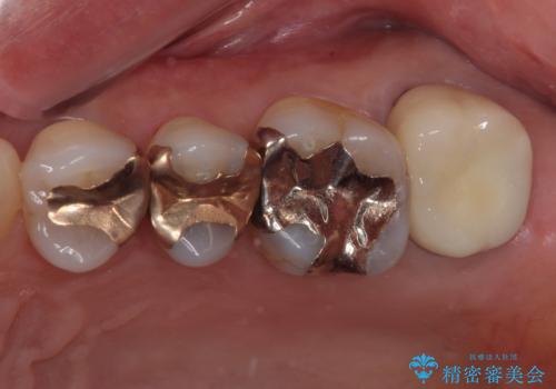 被せものに穴が開いたのでやり替えたい オールセラミッククラウンの症例 治療後
