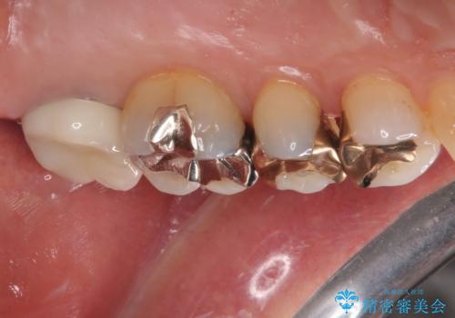 被せものに穴が開いたのでやり替えたい オールセラミッククラウンの治療後