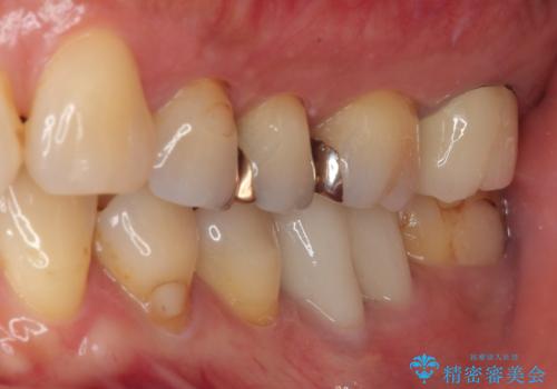 被せものに穴が開いたのでやり替えたい オールセラミッククラウンの治療後