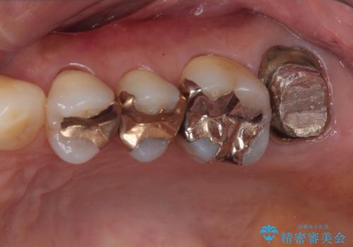 被せものに穴が開いたのでやり替えたい オールセラミッククラウンの治療中