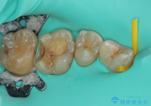 金属の詰め物がとれたので虫歯治療をしたい　セラミックインレー修復