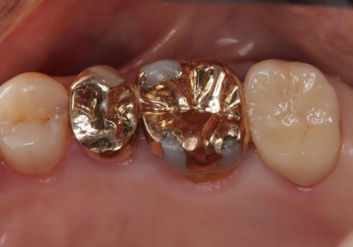 かぶせ物が外れたまま放置 伸びてしまった歯を修復の症例 治療後