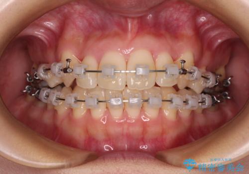 八重歯を改善 ワイヤー装置での抜歯矯正の治療中