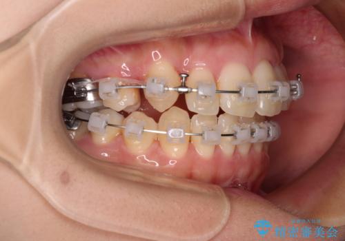 八重歯を改善 ワイヤー装置での抜歯矯正の治療中
