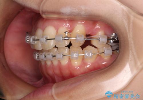 八重歯を改善 ワイヤー装置での抜歯矯正の治療中