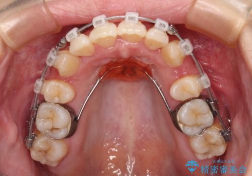 八重歯を改善 ワイヤー装置での抜歯矯正の治療中