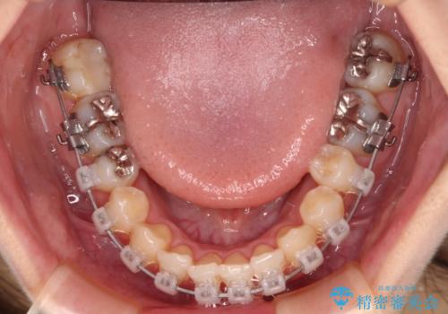 八重歯を改善 ワイヤー装置での抜歯矯正の治療中