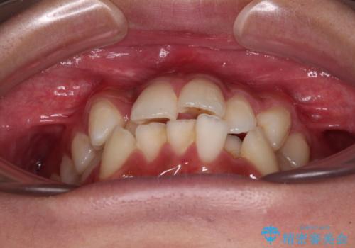 【モニター】デコボコ前歯をワイヤー装置での抜歯矯正で改善の治療前