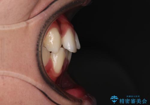 【モニター】デコボコ前歯をワイヤー装置での抜歯矯正で改善の治療前